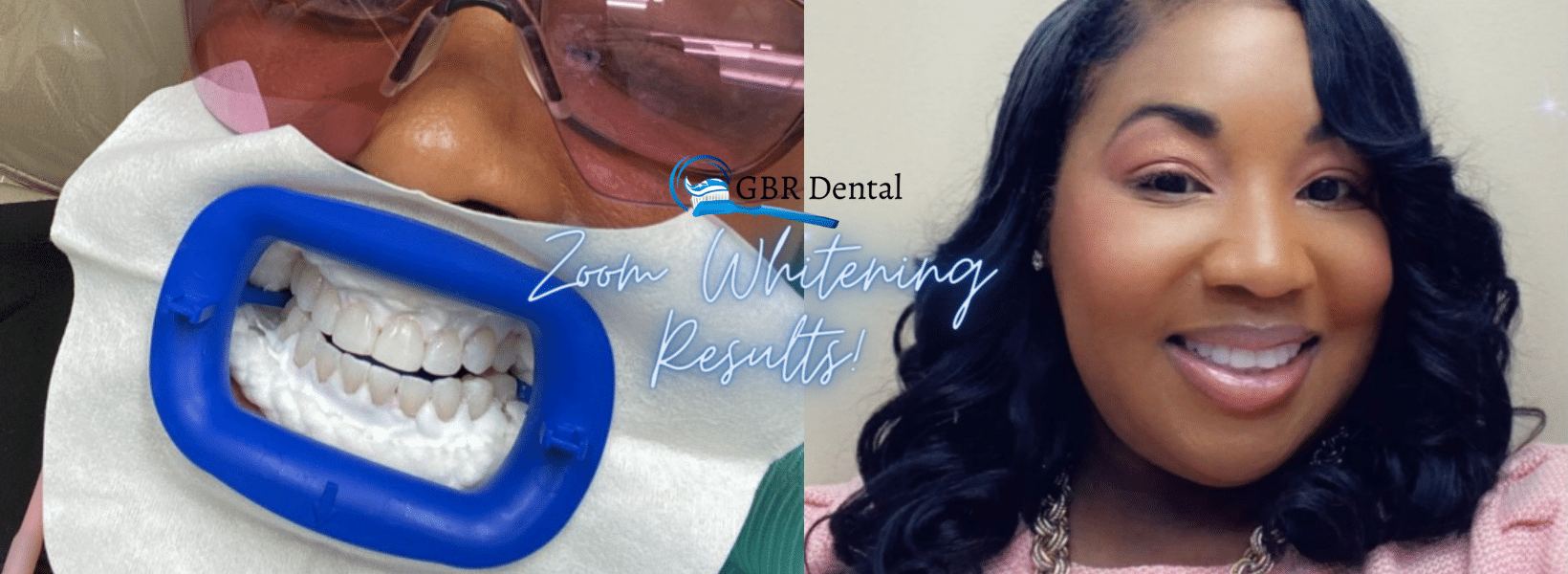 Brighten Your Smile With Teeth Whitening - GBR Dental